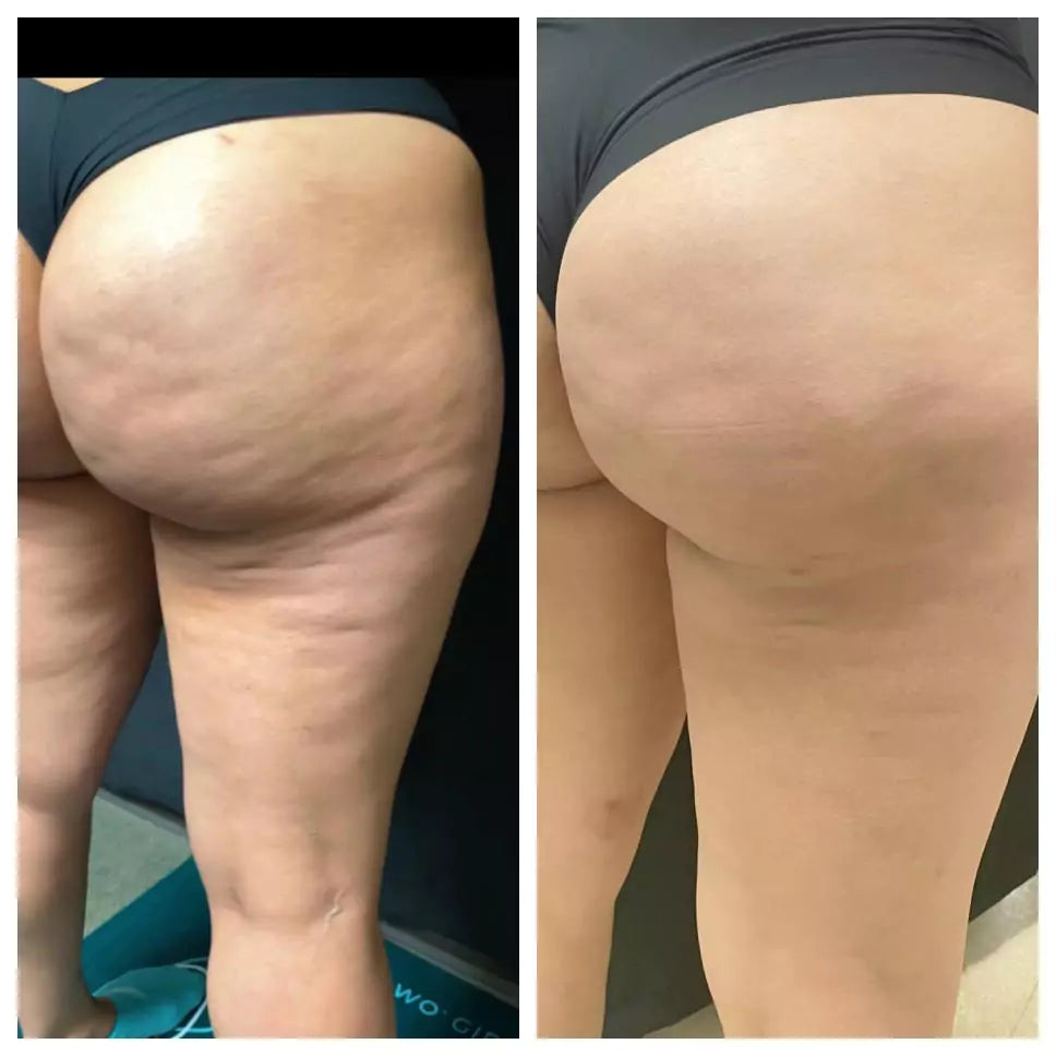 CelluSoothe™ Anti-Cellulite Body Oil – Firming, Smoothing & Skin-Toning Treatment